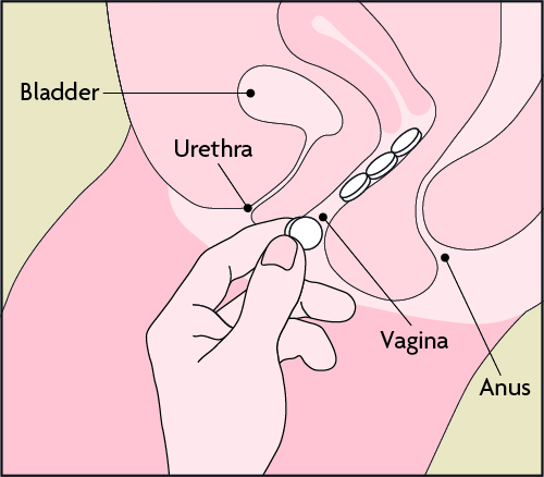 Inserting tablets in vagina